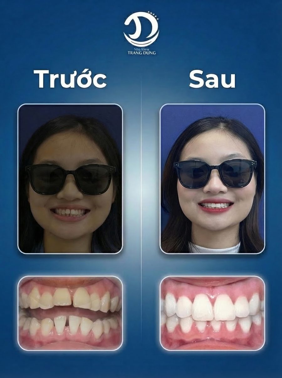 Ca niềng thực tế - trước và sau