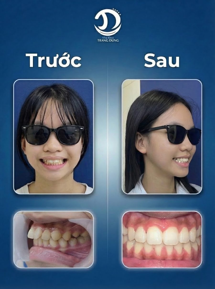 Ca niềng thực tế - trước và sau