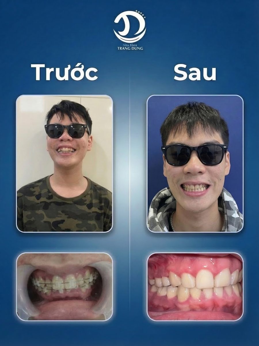 Ca niềng thực tế - trước và sau