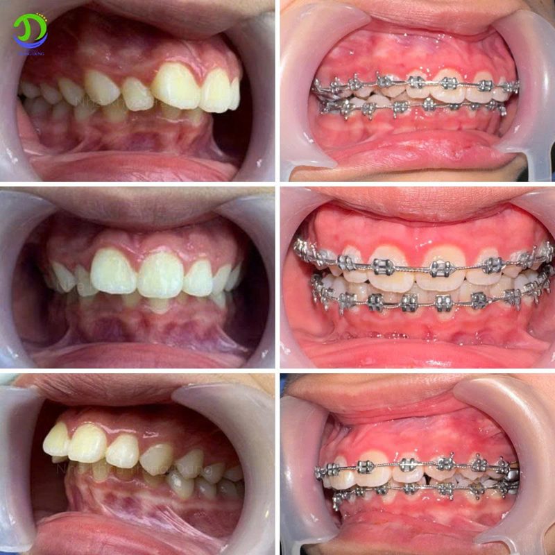Răng trước và sau khi niềng