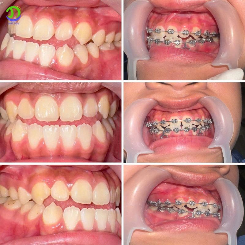 Răng trước và sau khi niềng